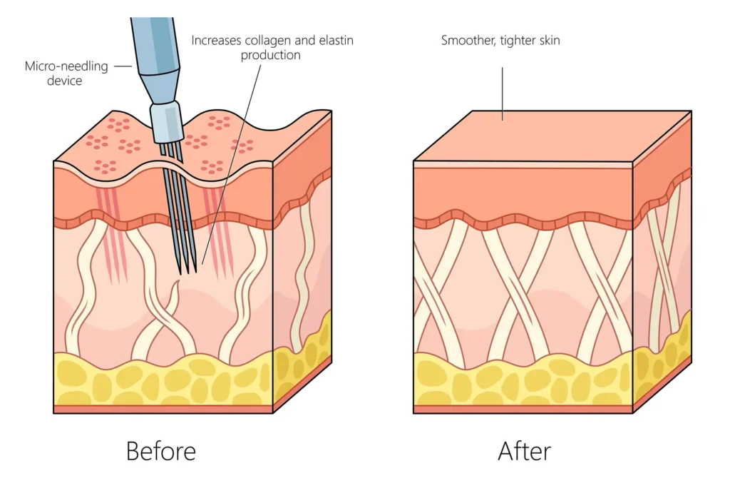 Microneedling works