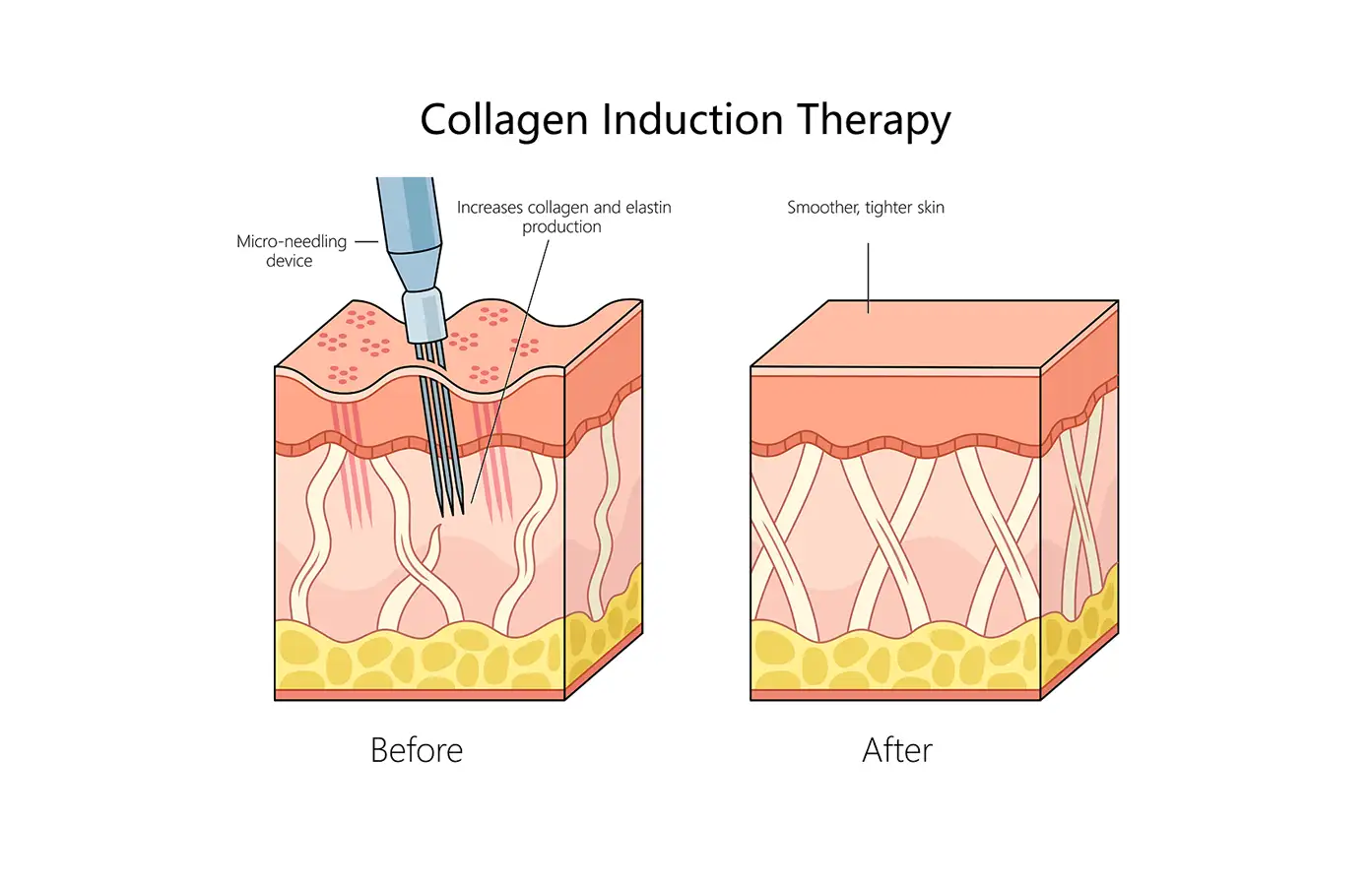 how microneedling works
